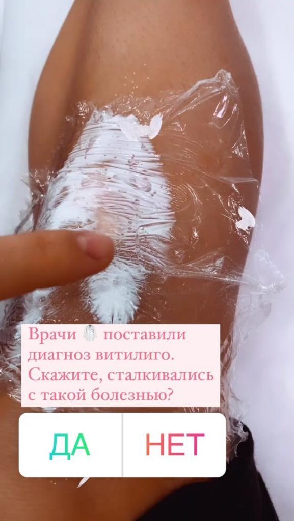 Регина Тодоренко витилиго